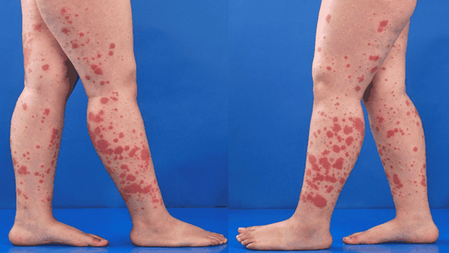 bai-viet/viem-mao-mach-di-ung-co-chua-duoc-khong.html