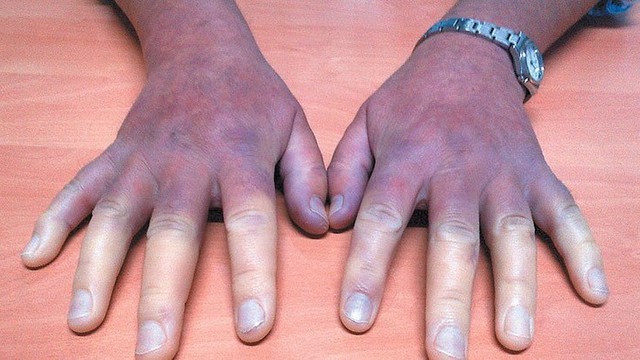 Xơ cứng bì toàn thể