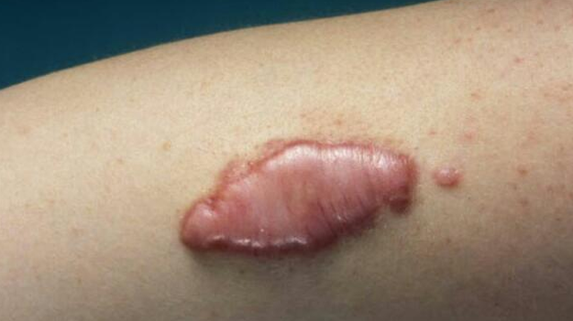 bai-viet/an-bap-co-bi-seo-loi-khong-nhung-thuc-pham-can-tranh-khi-co-vet-thuong-ho.html