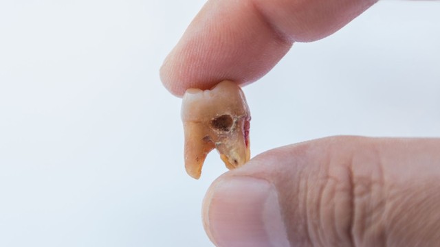 bai-viet/an-keo-sau-rang-hieu-dung-nguyen-nhan-va-cach-phong-ngua.html