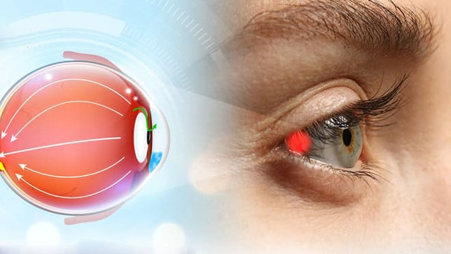 bai-viet/ap-luc-noi-nhan-la-gi-khi-nao-can-do.html