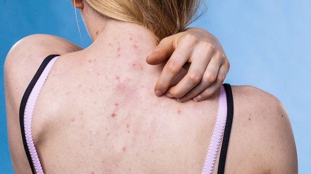 bai-viet/tham-khao-phuong-phap-tri-viem-nang-long-bang-aspirin.html