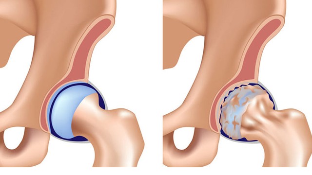 bai-viet/avn-la-gi-nguyen-nhan-va-cach-dieu-tri-can-benh-nay.html