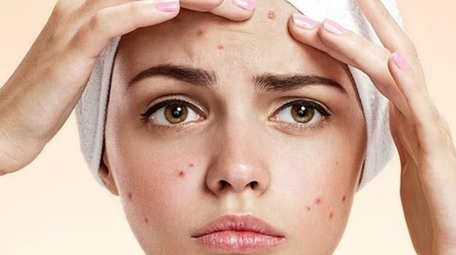 bai-viet/azaduo-co-day-mun-khong-azaduo-day-mun-theo-co-che-nao-va-trong-bao-lau.html