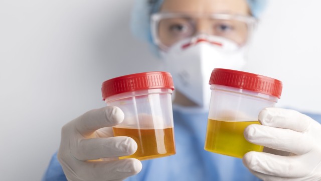 bai-viet/thac-mac-sau-khi-uong-canxi-nuoc-tieu-co-mau-vang-la-do-dau.html