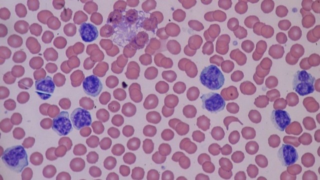 bai-viet/bach-cau-lympho-giam-co-nguy-hiem-khong.html