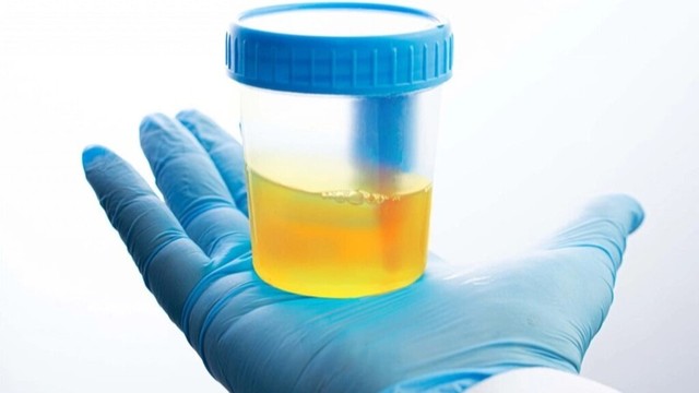 bai-viet/bach-cau-trong-nuoc-tieu-bao-nhieu-la-binh-thuong-luu-y-khi-do-bach-cau-trong-nuoc-tieu.html