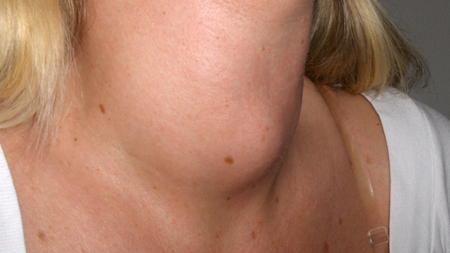 bai-viet/10-dau-hieu-benh-tuyen-giap-o-nu-pho-bien-chi-em-can-biet.html