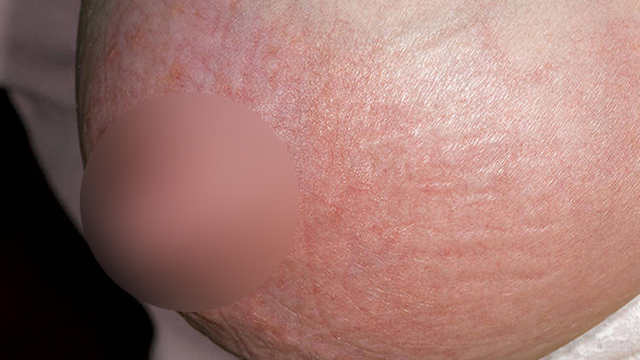 bai-viet/ap-xe-vu-co-mu-co-nguy-hiem-khong-cach-dieu-tri-ra-sao.html