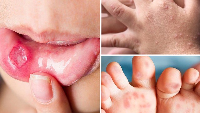 bai-viet/be-bi-tay-chan-mieng-lan-2-co-nhe-hon-lan-1-khong.html