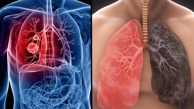 bai-viet/benh-ung-thu-phoi-song-duoc-bao-lau-giai-doan-cuoi-co-chua-duoc-khong.html