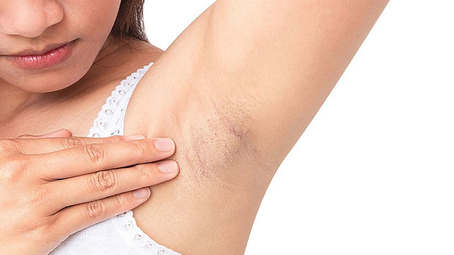 bai-viet/bi-bong-do-may-triet-long-nguyen-nhan-trieu-chung-va-cach-khac-phuc.html