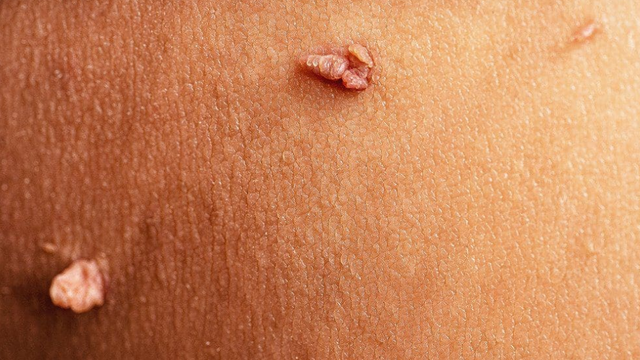 bai-viet/bi-sui-mao-ga-co-lay-vo-duoc-khong-nhung-luu-y-truoc-khi-cuoi-ban-can-biet.html