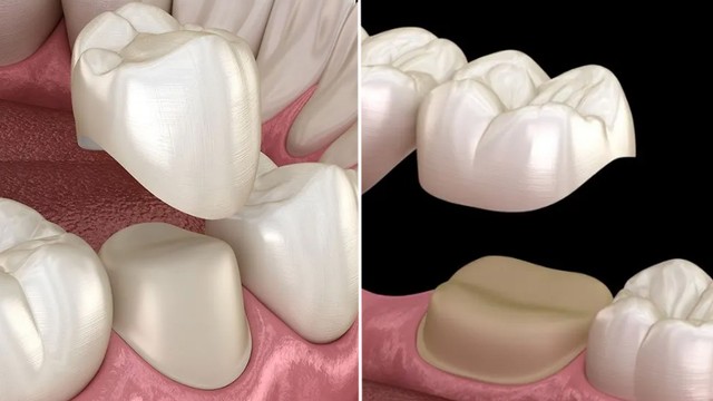 bai-viet/boc-rang-su-co-phai-nho-rang-khong-nhung-truong-hop-ngoai-le-can-luu-y.html