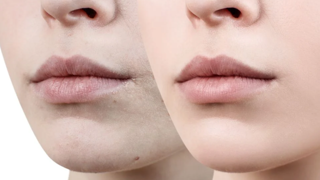 bai-viet/cach-tri-tham-moi-nhanh-trong-mot-tuan-bang-nguyen-lieu-tu-nhien.html