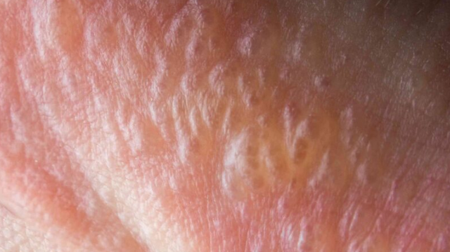 bai-viet/cau-nho-noi-mun-trang-khong-ngua-la-hien-tuong-gi.html