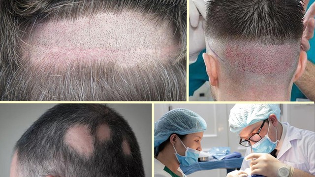 bai-viet/cay-toc-sinh-hoc-la-gi-co-nen-thuc-hien-khong.html