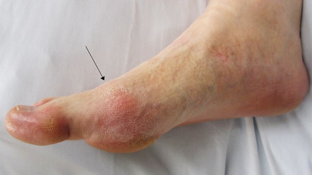 bai-viet/chi-so-axit-uric-450-la-da-bi-gout-chua-cach-phong-tranh-nong-do-axit-uric-tang-cao.html