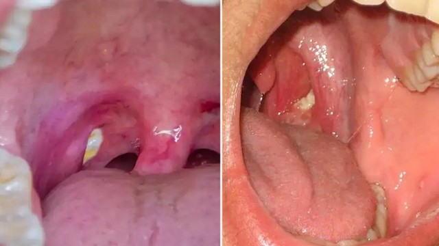 bai-viet/co-hat-nam-trong-ngach-cua-amidan-la-bi-gi-cach-dieu-tri-ra-sao.html