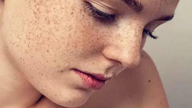 bai-viet/da-bi-tang-sac-to-sau-peel-la-hien-tuong-gi-co-khac-phuc-duoc-khong.html