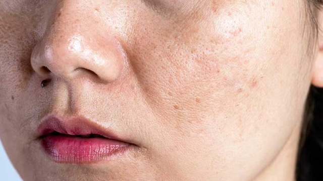 bai-viet/da-noi-dom-nau-khong-ngua-la-do-nguyen-nhan-nao.html