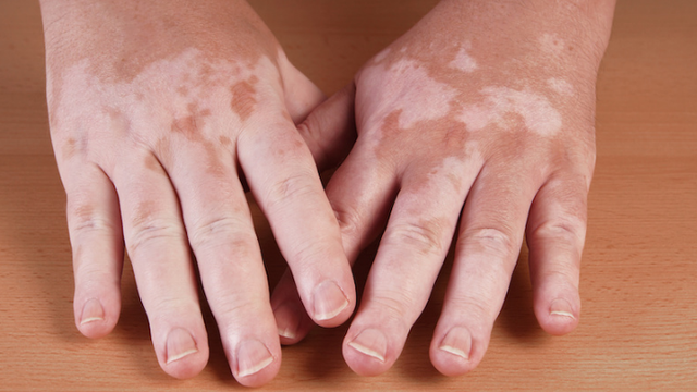 bai-viet/benh-bach-bien-co-chua-duoc-khong-cach-dieu-tri-the-nao.html