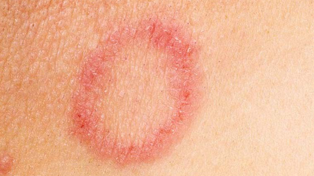 bai-viet/hien-tuong-bi-noi-vong-tron-do-tren-da-la-do-benh-ly.html