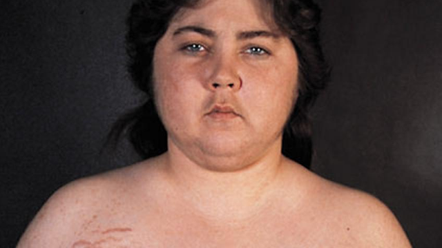 bai-viet/nguoi-mac-hoi-chung-cushing-nen-an-gi-va-kieng-gi.html