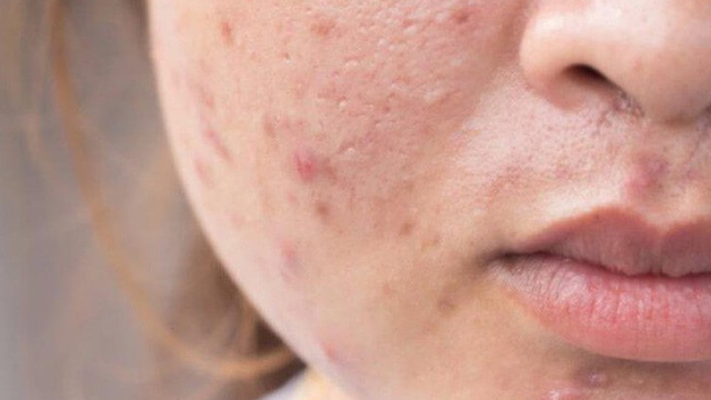 bai-viet/l70-trung-ca-dau-hieu-nhan-biet-va-cach-dieu-tri-hieu-qua.html