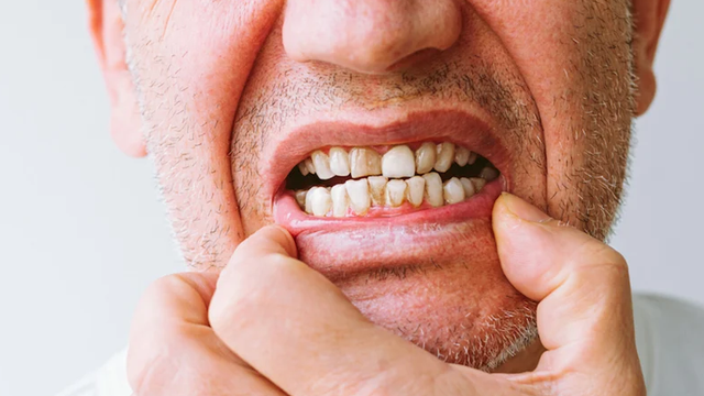 bai-viet/nguoi-60-tuoi-co-nen-trong-rang-khong-phuong-phap-trong-rang-nao-an-toan-hieu-qua.html