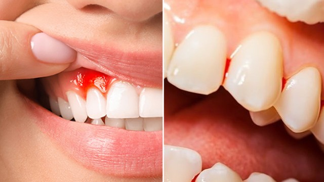 bai-viet/viem-loi-chay-mau-chan-rang-va-nhung-yeu-to-nguy-co.html