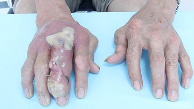 bai-viet/nhiem-trung-hat-tophi-la-gi-co-nguy-hiem-khong-va-cach-dieu-tri-the-nao.html