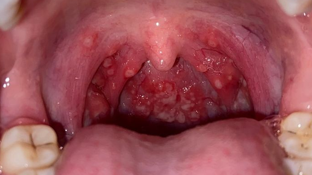 bai-viet/nhiet-mieng-trong-co-hong-nguyen-nhan-trieu-chung-va-cach-xu-tri.html