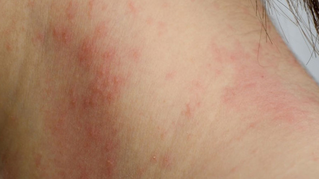 bai-viet/noi-man-do-khong-ngua-la-do-benh-ly-nao-co-nguy-hiem-khong.html