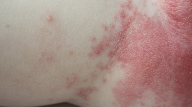 bai-viet/noi-man-do-ngua-o-hang-nu-gioi-la-hien-tuong-gi.html