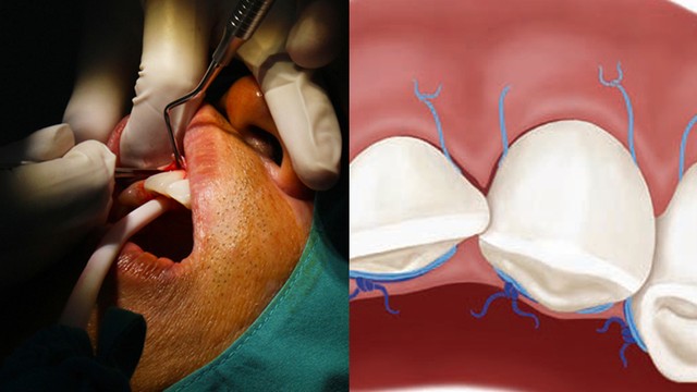 bai-viet/phau-thuat-lat-vat-la-gi-ai-nen-va-khong-nen-thuc-hien.html