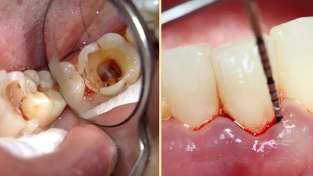 bai-viet/rang-sau-bi-chay-mau-do-nguyen-nhan-gi-cach-xu-ly-va-phong-ngua.html