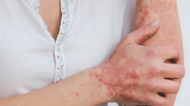 bai-viet/tang-sac-to-da-sau-viem-la-gi-cach-dieu-tri-ra-sao.html