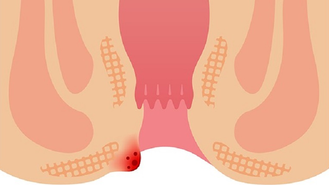 bai-viet/tri-ngoai-do-1-co-nguy-hiem-khong-chan-doan-va-dieu-tri-tri-ngoai-do-1-ra-sao.html