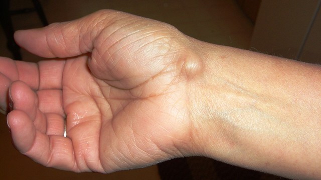 bai-viet/u-nang-hach-la-gi-nguyen-nhan-trieu-chung-va-bien-phap-dieu-tri-hieu-qua.html