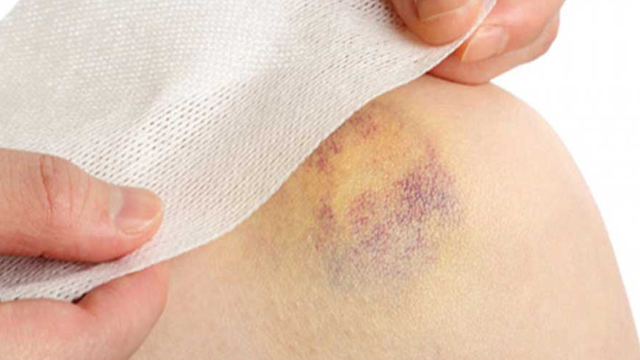 bai-viet/vet-bam-vang-tren-da-la-dau-hieu-cua-benh-gi.html