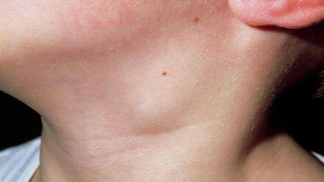 bai-viet/viem-hach-bach-huyet-o-tre-em-la-benh-gi.html