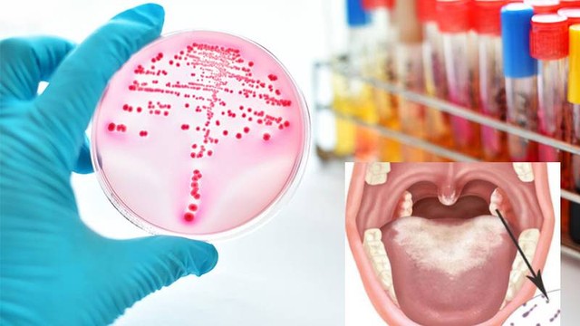 bai-viet/xet-nghiem-bach-hau-de-lam-gi-khi-nao-nen-xet-nghiem.html