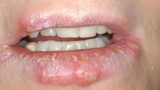 bai-viet/ban-biet-gi-ve-benh-viem-moi-do-nam.html