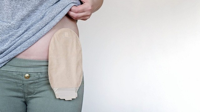 bai-viet/ban-biet-gi-ve-hau-mon-nhan-tao.html