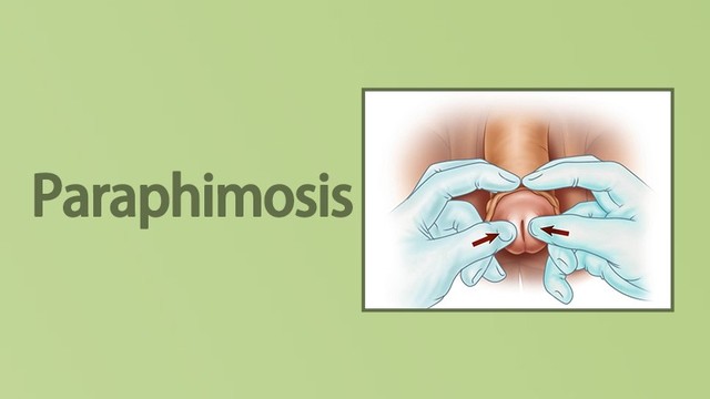 benh/ban-hep-bao-quy-dau.html