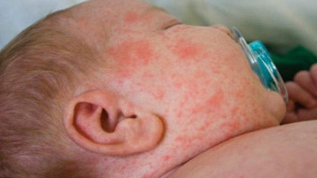 bai-viet/ban-xuat-huyet-giam-tieu-cau-huyet-khoi-la-gi-trieu-chung-va-phuong-phap-dieu-tri-benh-hien-nay.html