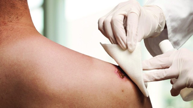 bai-viet/phai-lam-sao-khi-bang-gac-bi-dinh-vao-vet-thuong-61576.html