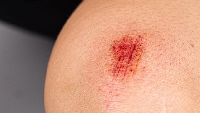 bai-viet/bao-lau-da-non-het-do-5-cach-cham-soc-vet-thuong-len-da-non.html