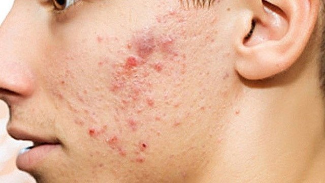 bai-viet/bat-mi-cach-tri-mun-boc-sung-do-cuc-don-gian-65723.html